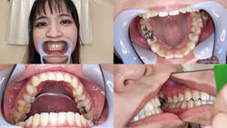 【치아 페티쉬】미야자키 린의 치아를 관찰했습니다!